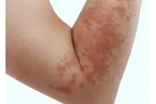 Bebekler Neden Pişik Olur?